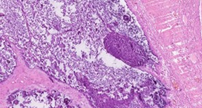 Pathological diagnosis: (right chest wall) significant calcification and granuloma reaction were found. Combined with the history of nephropathy, it was consistent with secondary tumor like calcification