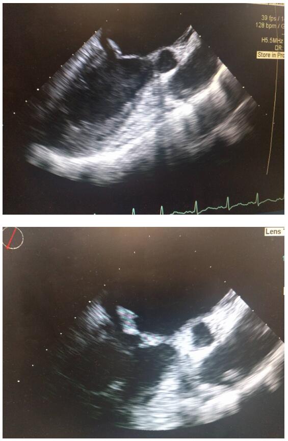 Moderately severe mitral regurgitation (+3) was present as below