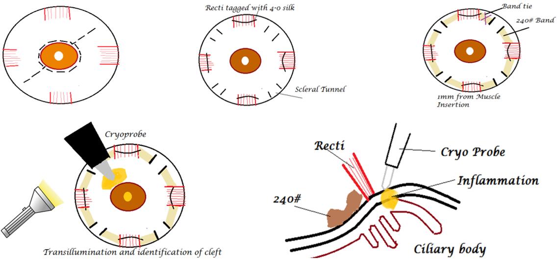 Surgical steps in encirclage for cyclodialysis